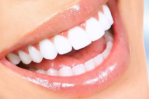 teeth-whitening-01